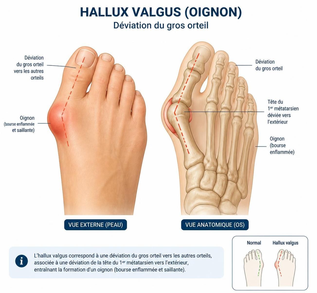 découvrez les causes, symptômes et solutions efficaces pour soulager les douleurs liées à l'hallux valgus, une déformation fréquente du pied.