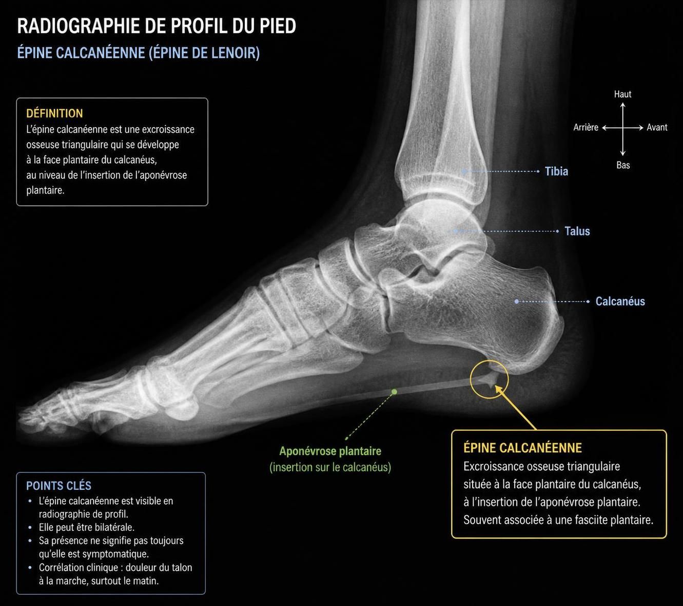 découvrez comment le diagnostic par radio permet d'identifier une épine calcanéenne, ses symptômes et les méthodes d'examen pour mieux comprendre cette affection du pied.
